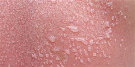 why is my sunburn leaking yellow|How Long Sunburn Blisters Last and How to Get Rid。